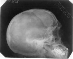 -ray of the skull of Science Service astronomy editor James Stokley 